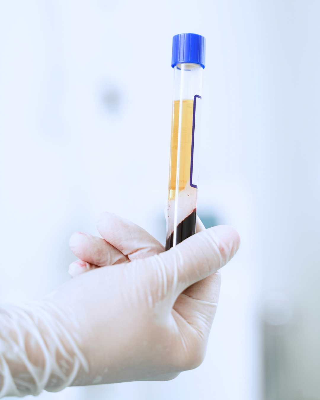 PRP tube used for platelet-rich plasma microneedling add-on at Eternal MedSpa