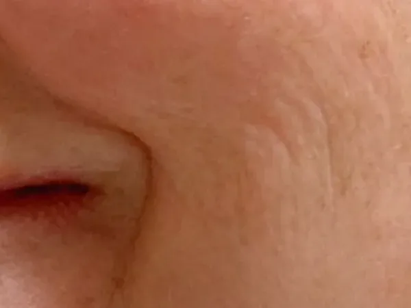 After: the same guest's cheek, after laser skin treatment