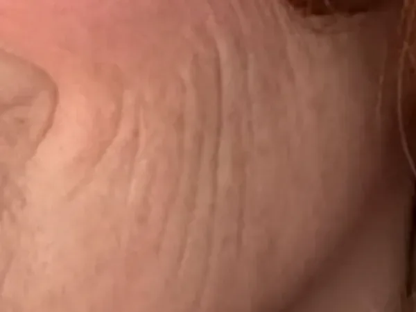 Before: a guest's cheek, before laser skin treatment