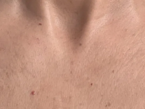 After: the same guest's chest, after IPL