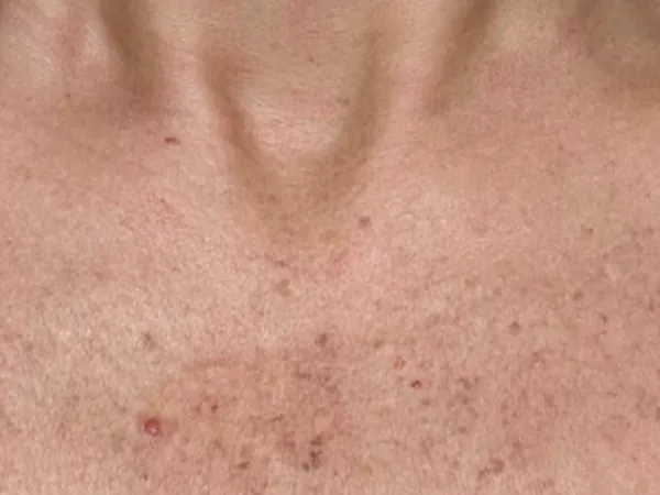Before: sun spots on a guest's chest, before IPL