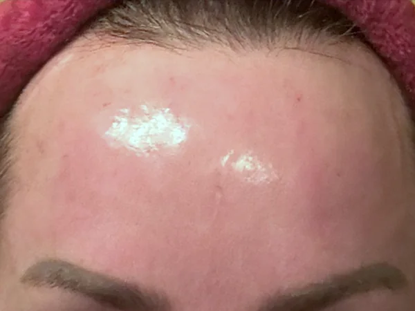 After: the same guest's forehead, smoother, two weeks after DualMode laser