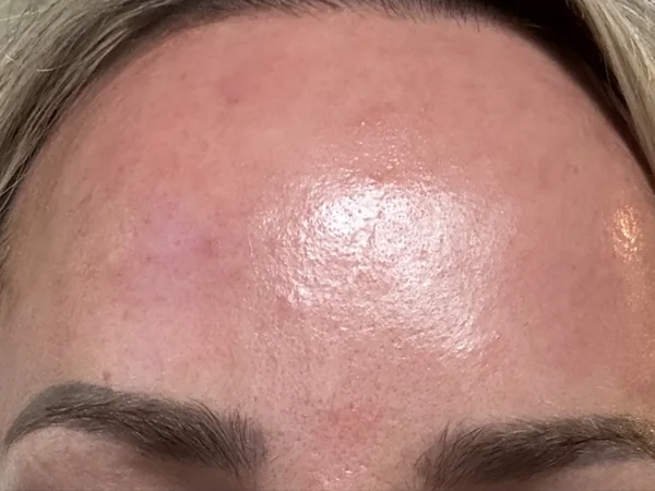 Before: a guest's forehead with uneven texture and pores, before DualMode laser