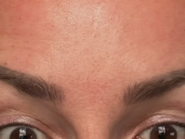 After: the same guest's forehead and brows, two weeks after tox (neuromodulator) for forehead lines