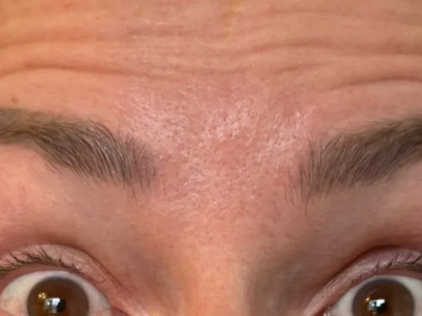 Before: a guest's forehead and brows, before tox (neuromodulator) for forehead lines