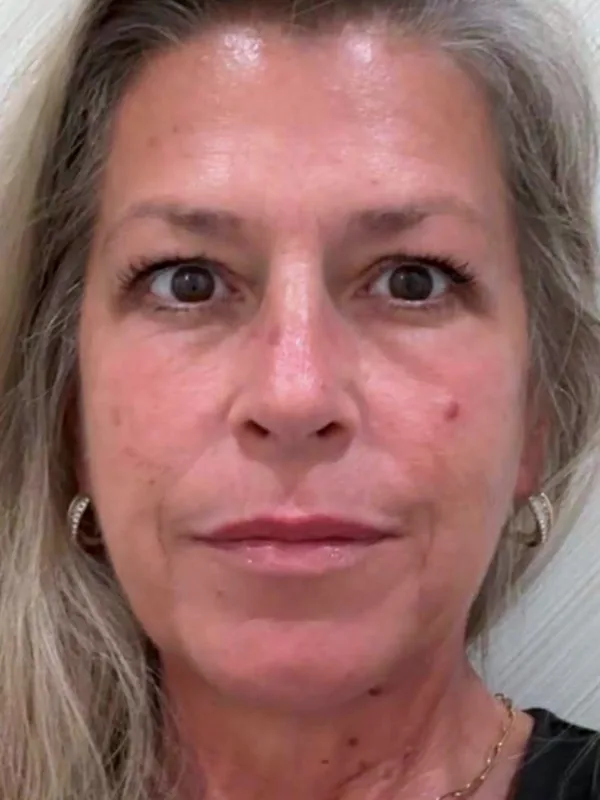 After: the same guest's face, front view, three months later