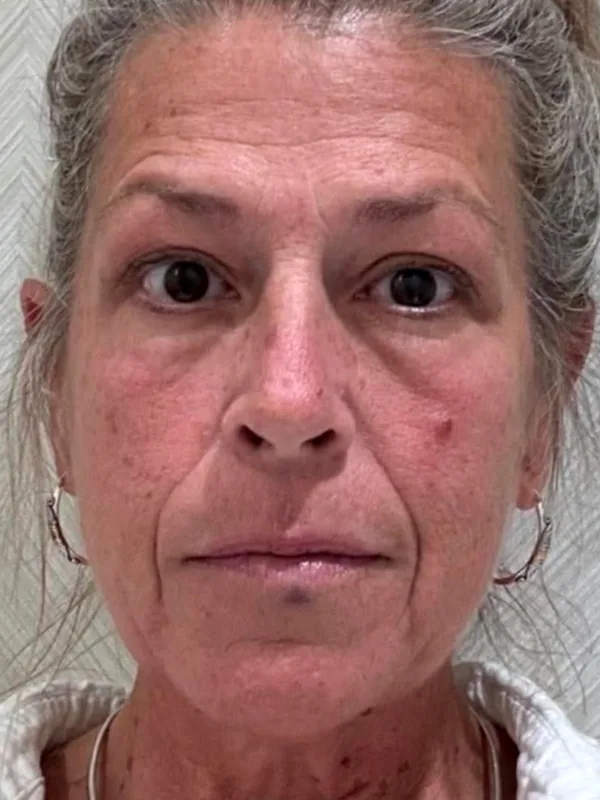 Before: a guest's face, front view, before tox, dermal filler and medical-grade skincare