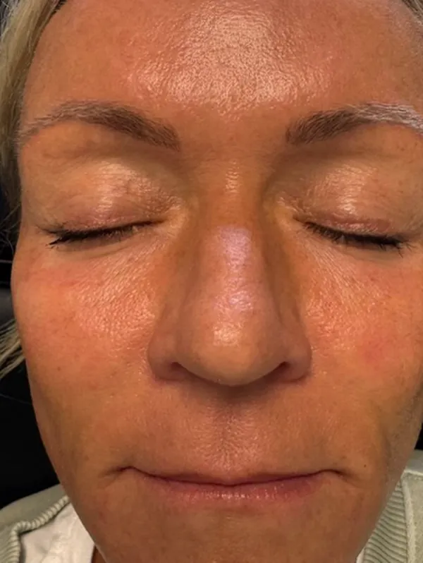 After: the same guest, eyes closed, about two months later, after tox, dermal filler and medical-grade skincare