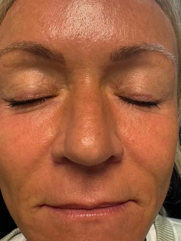 Before: a guest's face, eyes closed, before treatment