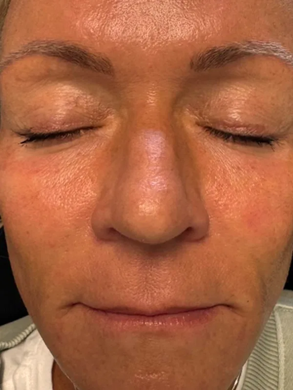 After: the same guest, eyes closed, about two months later, after tox, dermal filler and medical-grade skincare