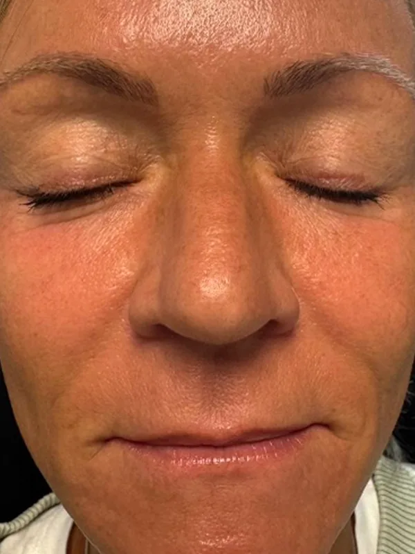 Before: a guest's face, eyes closed, before treatment