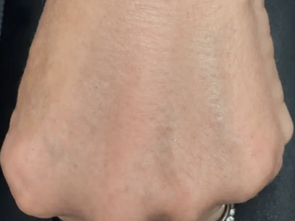 After: the back of the same guest's hand, after hand filler