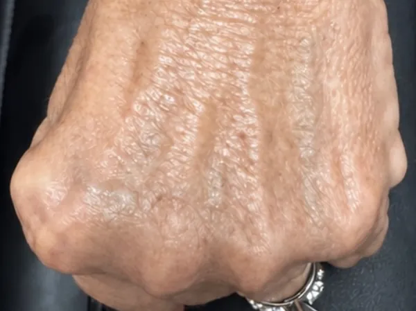 Before: the back of a guest's hand, before hand filler