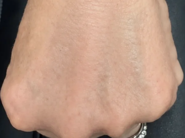 After: the back of the same guest's hand, after hand filler