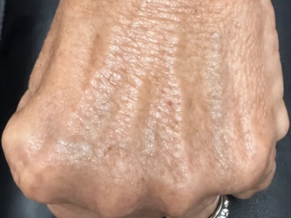 Before: the back of a guest's hand, before hand filler