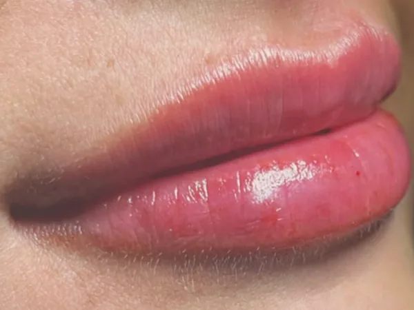 After: the same guest's lips, angled view, after lip filler