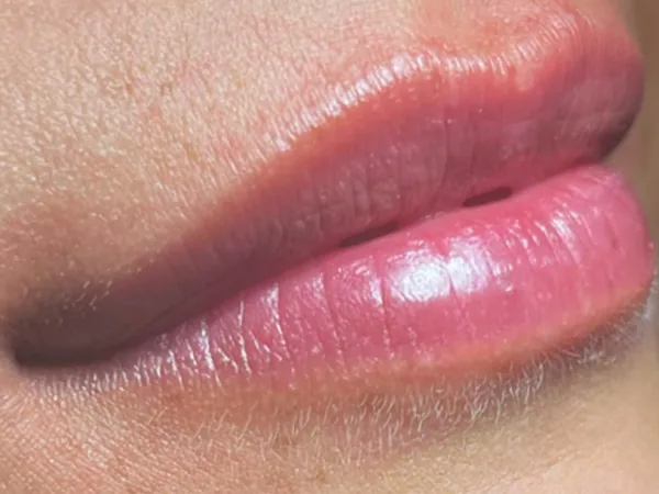 Before: a guest's lips, angled view, before lip filler