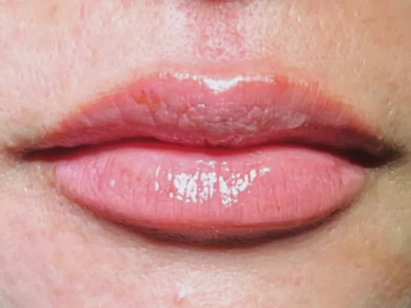 After: the same guest's lips, front view, after lip filler