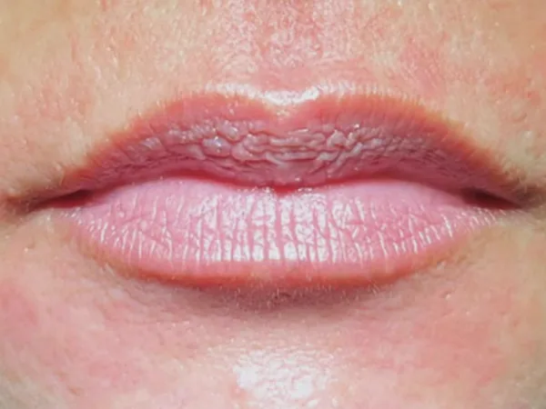 Before: a guest's lips, front view, before lip filler
