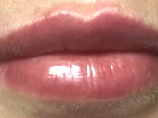 After: the same guest's lips, front view, after lip filler