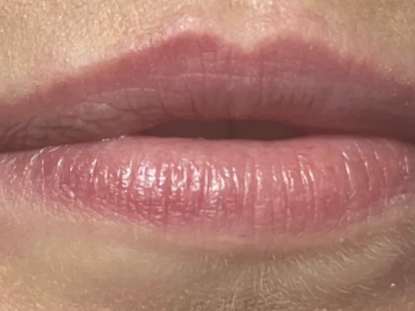 Before: a guest's lips, front view, before lip filler