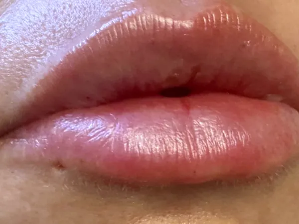 After: the same guest's lips, close-up, after lip filler