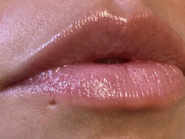 Before: a guest's lips, close-up, before lip filler