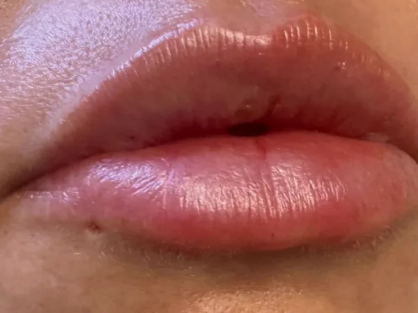 After: the same guest's lips, close-up, after lip filler