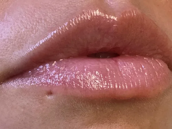 Before: a guest's lips, close-up, before lip filler