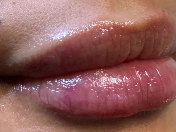 After: the same guest's lips, angled close-up, after lip filler