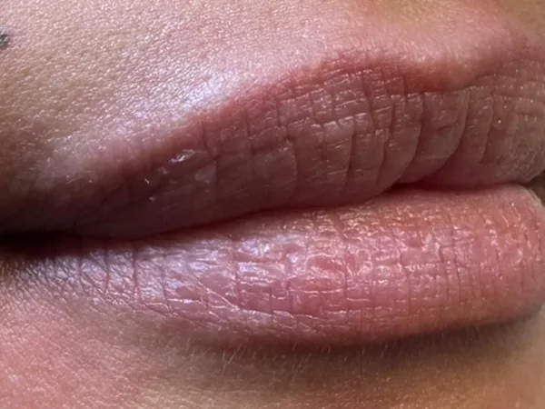 Before: a guest's lips, angled close-up, before lip filler