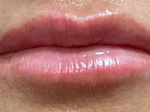 After: the same guest's lips, front view, after lip filler
