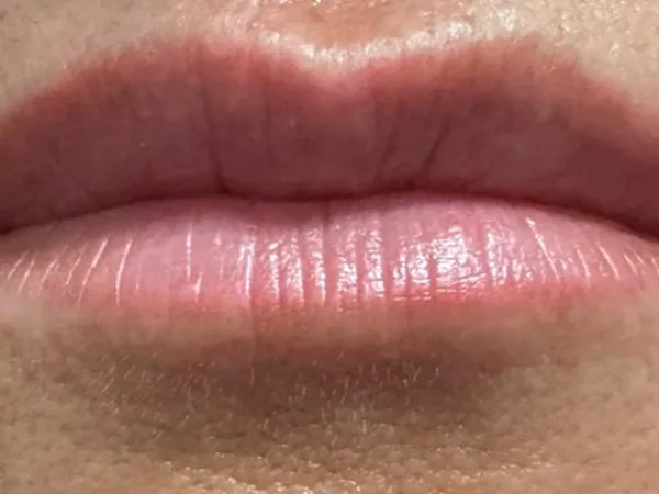 Before: a guest's lips, front view, before lip filler