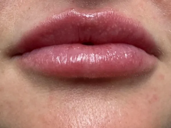 After: the same guest's lips, front view, after lip filler