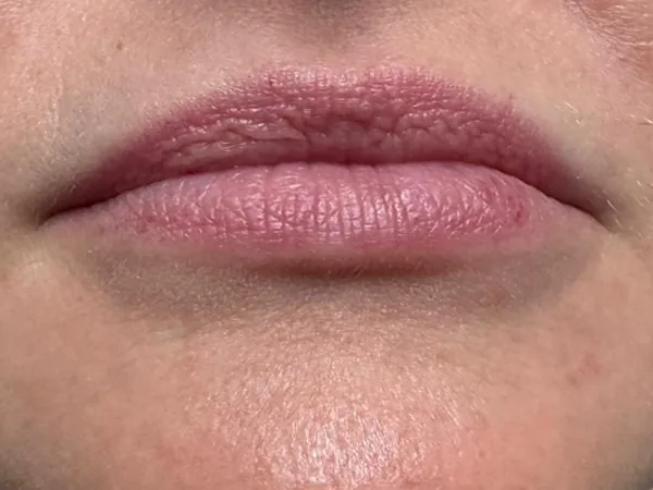 Before: a guest's lips, front view, before lip filler