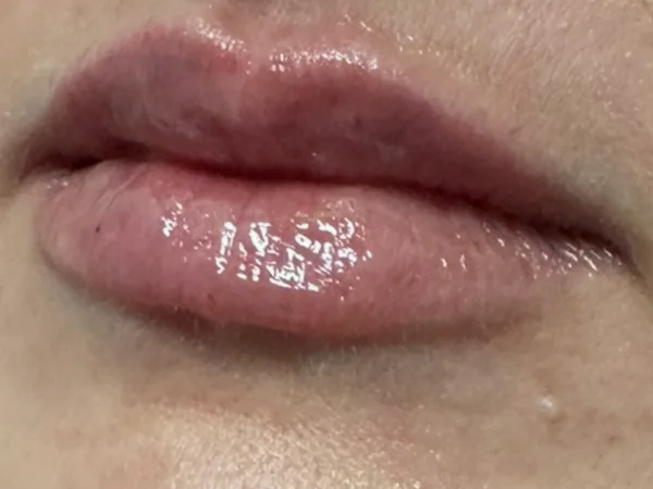 After: the same guest's lips, left angle, after lip filler