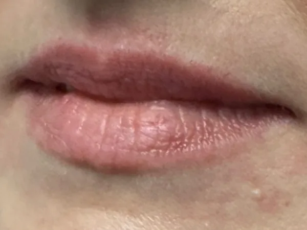 Before: the same guest's lips, left angle, before lip filler