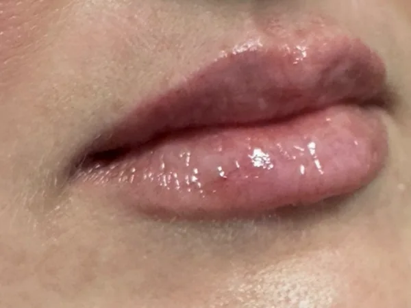 After: the same guest's lips, right angle, after lip filler