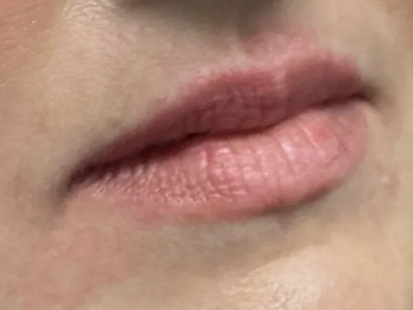 Before: the same guest's lips, right angle, before lip filler