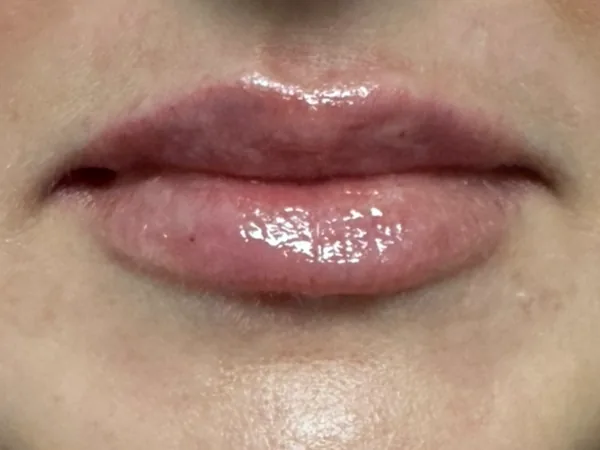 After: the same guest's lips, front view, after lip filler