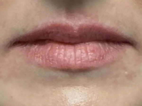 Before: a guest's lips, front view, before lip filler