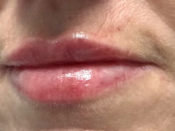 After: the same guest's lips, close-up, after lip filler