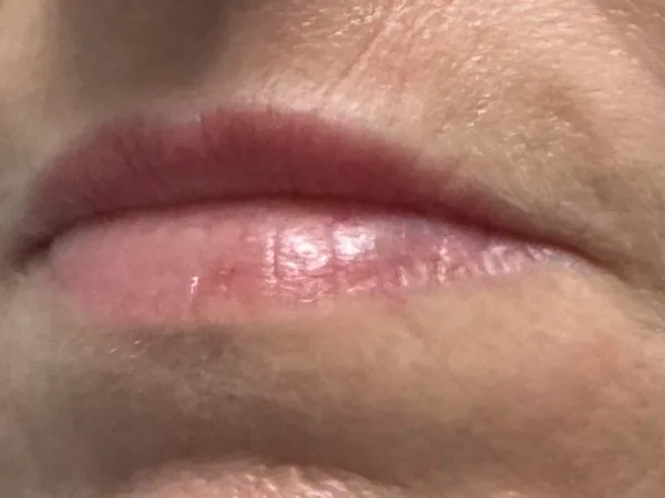 Before: a guest's lips, close-up, before lip filler