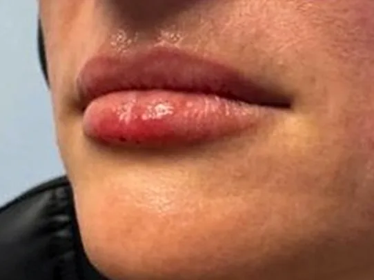 After: the same guest's lips, left angle, after lip filler
