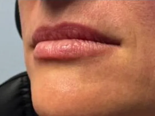 Before: the same guest's lips, left angle, before lip filler