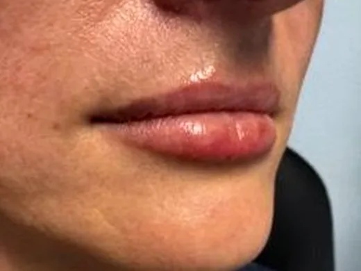 After: the same guest's lips, right angle, after lip filler