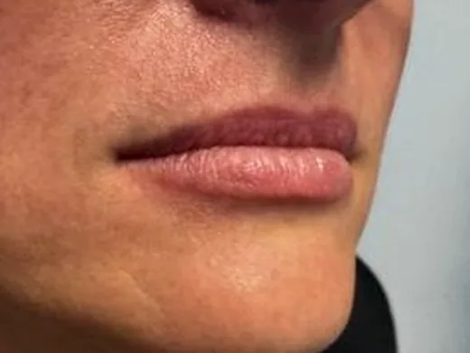 Before: the same guest's lips, right angle, before lip filler