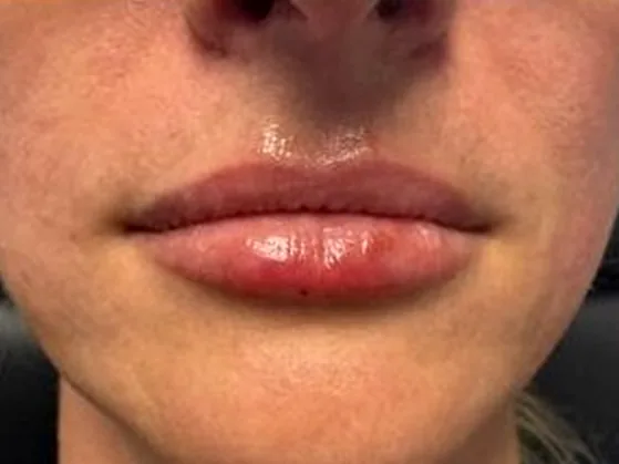 After: the same guest's lips, front view, after lip filler