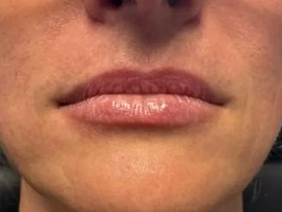 Before: a guest's lips, front view, before lip filler