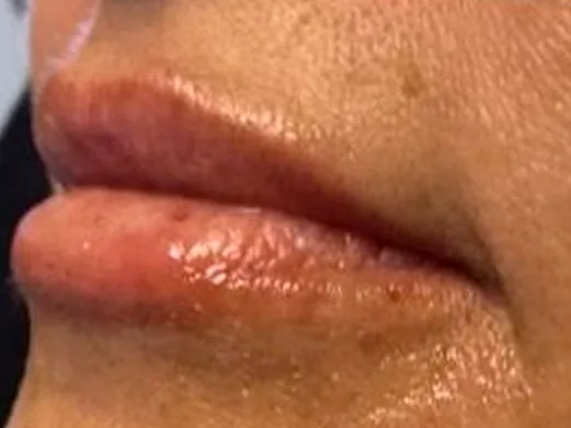 After: the same guest's lips, left angle, after lip filler